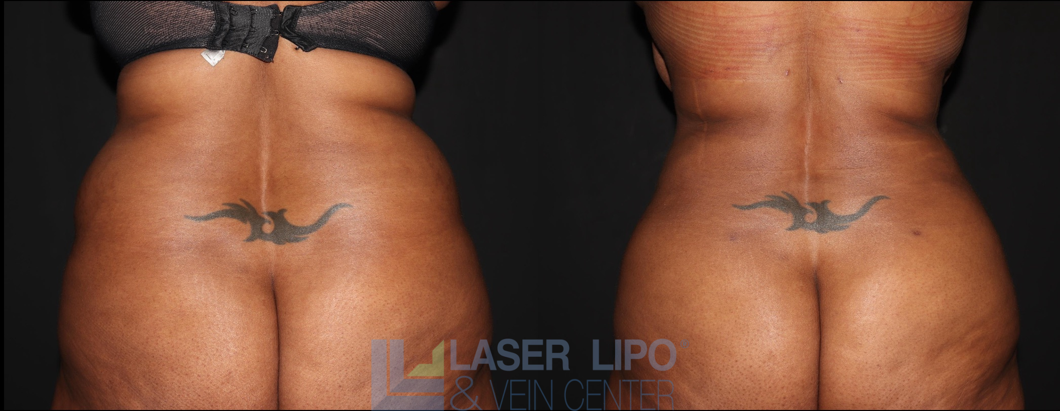 Before and After Image: Liposuction – Back